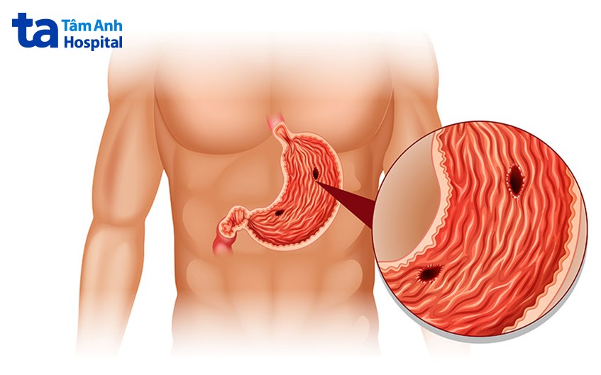 Dạ dày là gì? Cấu tạo, vị trí nằm ở đâu và cách chăm sóc