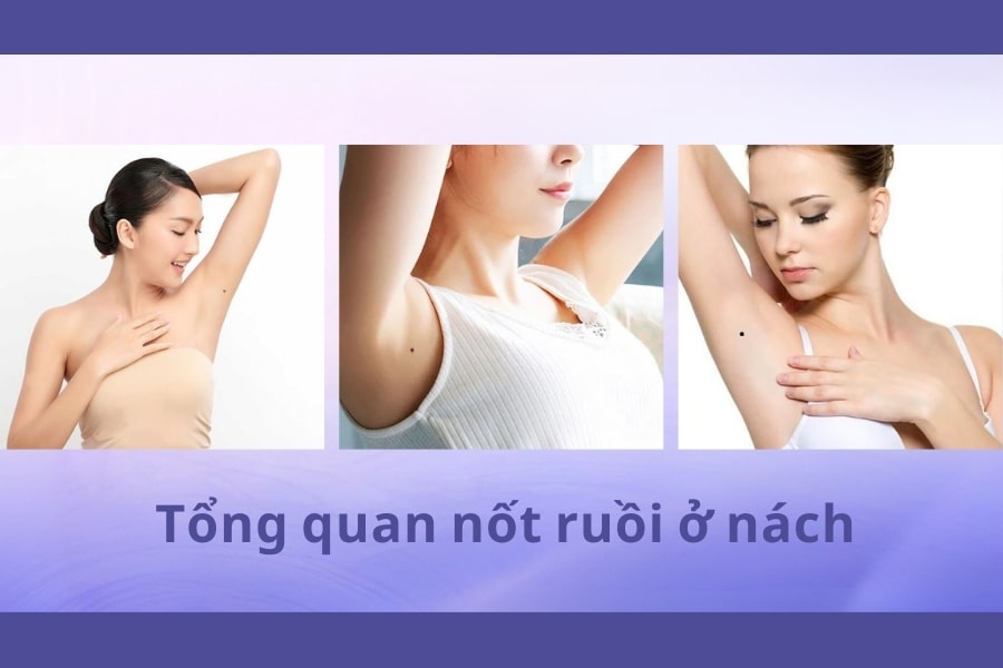 Nốt ruồi ở nách mang ý nghĩa tốt hay xấu? Có nên xóa không?