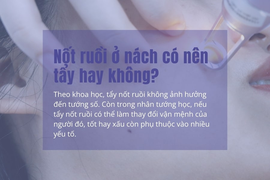 Nốt ruồi ở nách mang ý nghĩa tốt hay xấu? Có nên xóa không?